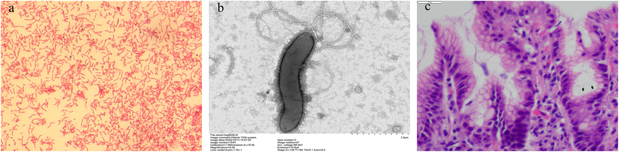 Figure 2: 
Morphology of Helicobacter pylori. (a) Gram staining of H. pylori (×1,000). H. pylori is Gram negative; (b) transmission electron microscope (TEM) image of H. pylori (×5,000). H. pylori is a curved, elongated bacterium with prominent flagella, facilitating its penetration of the thick mucous layer in the stomach; (c) Histologic manifestations of H. pylori infection (HE staining, ×400). H. pylori is visible as small red rods (arrows) on the epithelial surface and within the glands. The underlying mucosa shows inflammatory cells infiltration.