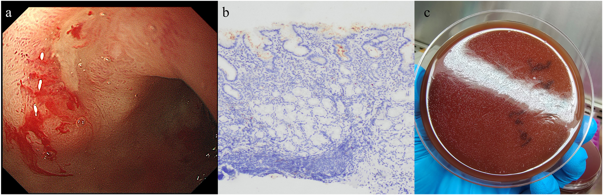 Figure 3: 
Teaching materials in case-based learning (CBL). (a) Image of endoscopic examination. Gastric ulcer with active bleeding was observed. (b) Histologic examination of Helicobacter pylori infected tissue (immunohistochemistry, ×40). H. pylori is stained brown in the gastric epithelial layer. (c) H. pylori colonies on culture medium (brain-heart infusion blood agar). Small, transparent colonies appeared on the plate after 96 h of culture.