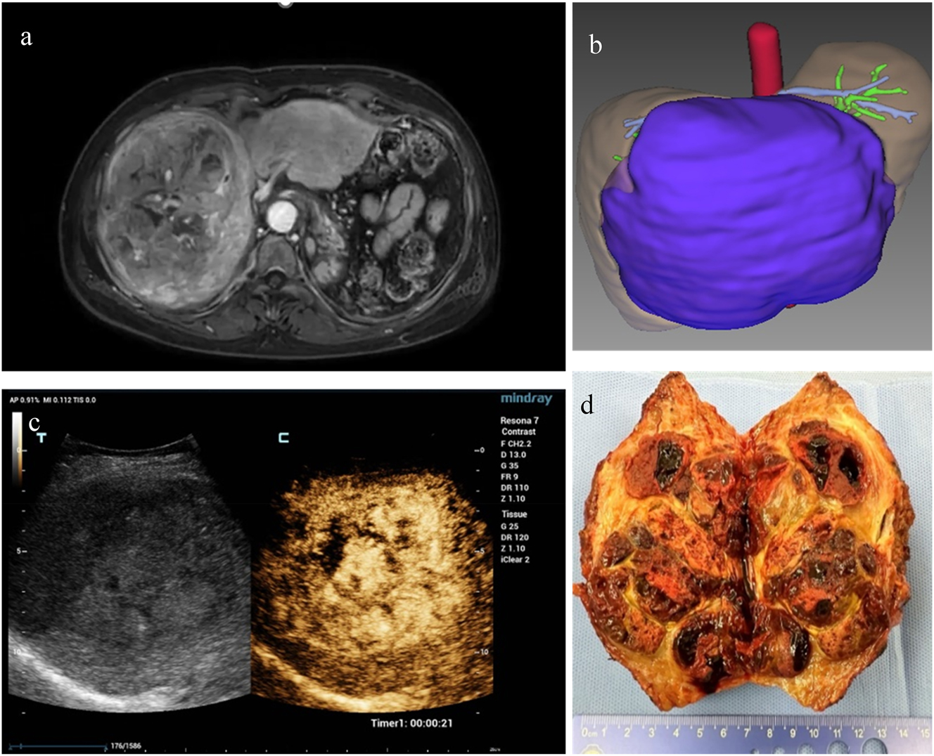 Figure 3:
Teaching materials in CBL learning. (a) MRI of a large hepatic mass (T1WI enhancement). (b) CT-based three-dimensional reconstruction image of the liver for surgical planning. (c) Ultrasound contrast imaging of the hepatic lesion. (d) Ex vivo image of surgical specimen after hepatectomy. CBL, case-based learning.