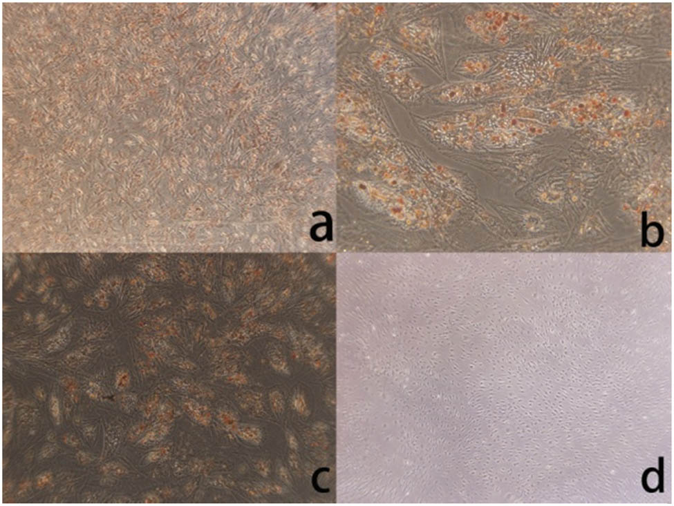 Figure 3 
               (a) After ADMSCs differentiate into adipose, the cell morphology is no longer fusiform (×40), and cell morphology changes. (b) After adipogenic differentiation of ADMSCs, the cells changed from spindle to triangle or irregular shape (×200). (c) After adipogenic differentiation of ADMSCs, oil red O staining showed intracellular red lipid droplets (×40). (d) There was no significant change without adipogenic differentiation cells (×40).
            
