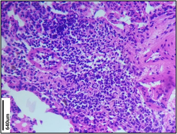 Figure 5 
                  Histopathological study of Group VI lung section (sensitized group). Massive infiltration of inflammatory cells in the interstitial space was observed in the sensitized group. The sensitized group also showed emphysema, hyperplasia, and necrosis.
               