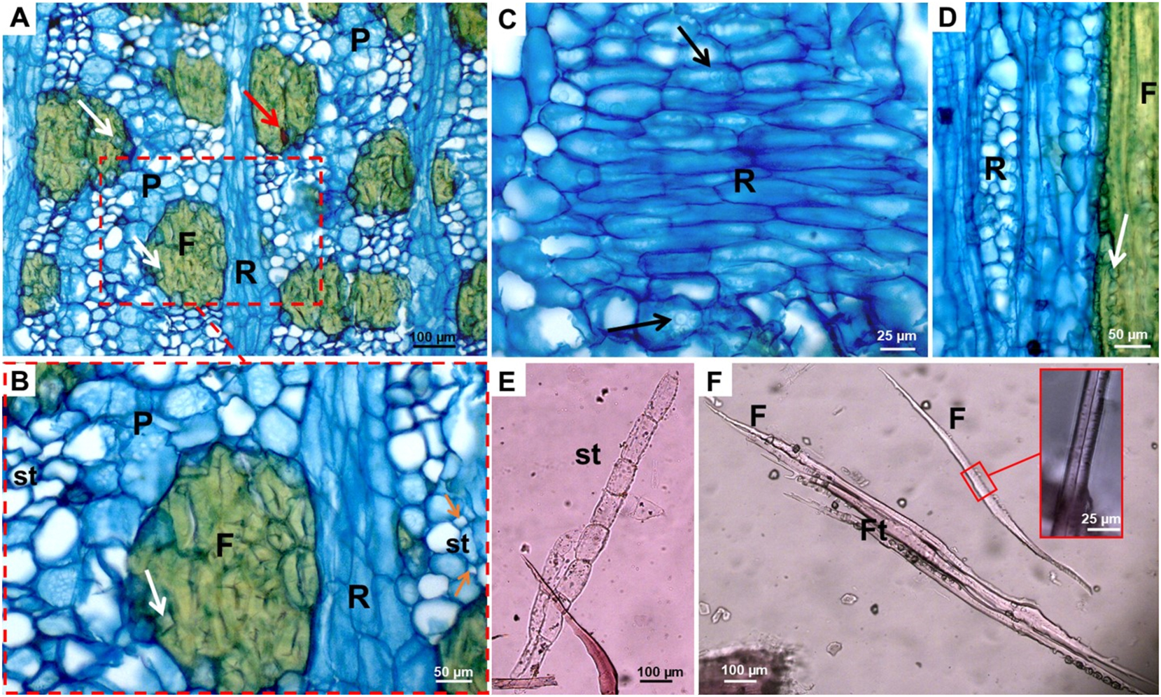 Figure 5: 
Anatomical aspects of the Byrsonima spicata bark. (A) Conductive phloem with prismatic crystals [white arrow] and contents [red arrow] adhered in sclereid-fibre clusters, and demarcated zone enlarged in detail; (B) tube element [st] with companion cells [orange arrow], crystals [white arrow] and axial parenchyma [P] and radius [R]; (C) radial longitudinal section showing ray cells [R] and occurrence of crystalline sand [arrow]; (D) ray cells in tangential section and crystals lined in fibrous zone [arrow]; (E) tube element [st]; (F) fibres [F] with enlarged zone showing the cell wall and sclereid fibres [Ft].
