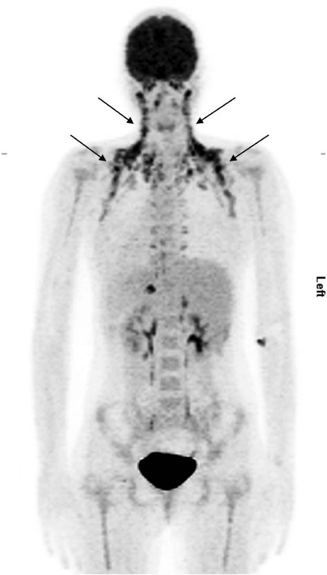 Figure 2 Active brown adipose tissue visualized by 18fluor-deoxy-glucose positron emission tomography coupled with computed tomography (arrows). Provided by the Division of Nuclear Medicine, Department of Radiology and Nuclear Medicine, Medical University of Vienna.