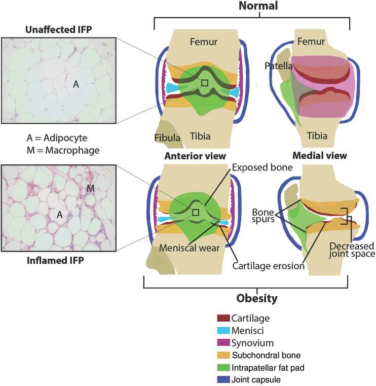 Figure 1: Representative images (anterior and medial views) of the intact knee organ under normal conditions where OA is not present (top aspect of figure) vs. OA in the context of obesity (bottom aspect of figure).Insets to the left show histomicrographs (200× magnification) of IFP in lean vs. obese 5 month-old guinea pigs. Demonstrated changes associated with OA include: loss/erosion of cartilage, decreased joint space, meniscal wear, and exposed subchondral bone. Please note that, in the medial view of the obese knee, synovium (pictured in the medial view of the normal knee) has been removed to allow viewing of these OA-related changes. Finally, it should be emphasized that, while obesity is a primary risk factor for OA, obesity is not ubiquitous for OA to occur and lean individuals can also experience this disease. Image created for present publication by Josie Fouts with Adobe Photoshop (Adobe Systems Incorporated, San Jose, CA, USA).