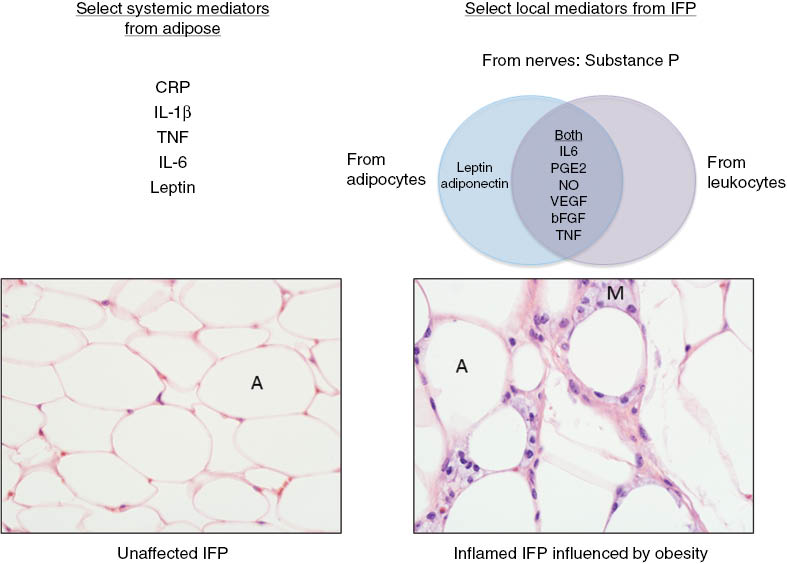 Figure 3: Select systemic (left) and local (right) mediators secreted from adipose tissue throughout the body and the IFP, respectively.Sources of mediators in the IFP have been divided into nerves, adipocytes, and leukocytes. Photomicrographs (500× magnification) of unaffected (left) and inflamed (right) IFP from lean vs. obese 5 month-old guinea pigs are shown. A, Adipocyte; M, macrophage. Image created in Powerpoint (Microsoft Windows, Redmond, WA, USA).
