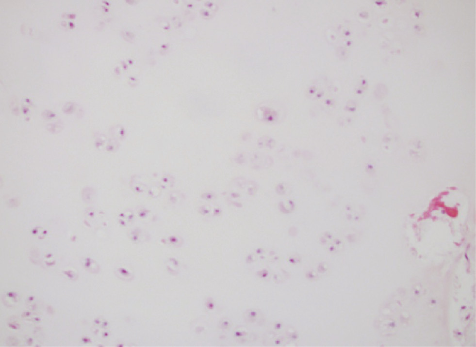 Figure 1: Metastatic chondrosarcoma with scattered chondrocytes set in hyaline cartilage (hematoxylin and eosin, original magnification ×200).