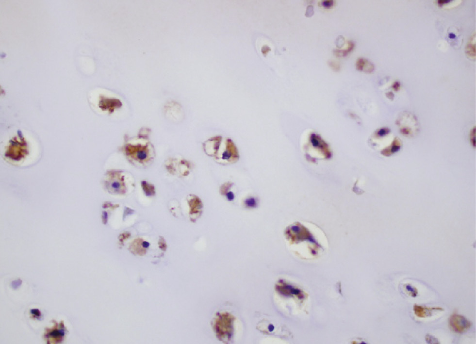 Figure 2: Metastatic chondrosarcoma with the cytoplasm staining at mostly 4+ intensity for LHRH-R (immunohistochemistry, original magnification ×400).