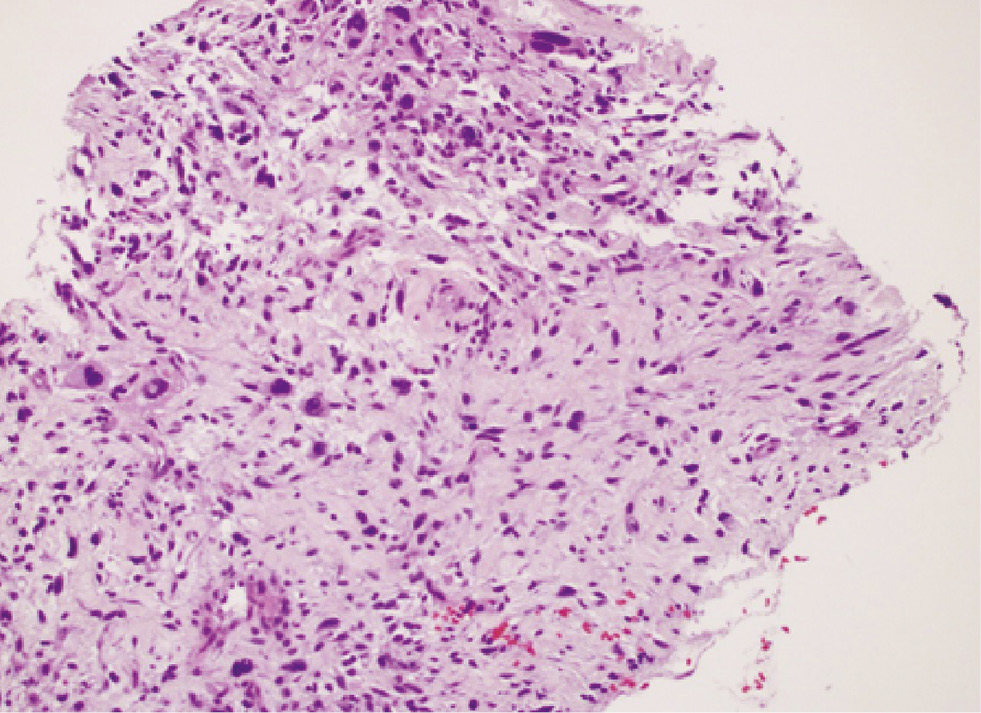 Figure 3: Dedifferentiated liposarcoma showing nuclear pleomorphism (hematoxylin and eosin stain, original magnification ×200).