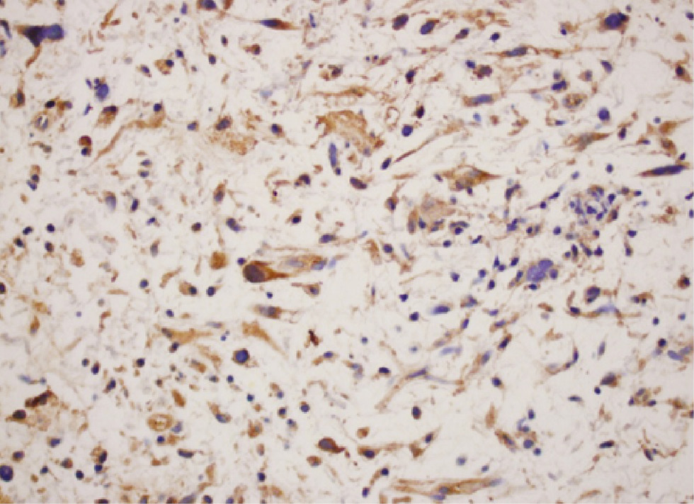 Figure 4: Dedifferentiated liposarcoma showing diffuse cytoplasmic staining (4+) for the LHRH-R (immunohistochemistry, original magnification ×400).