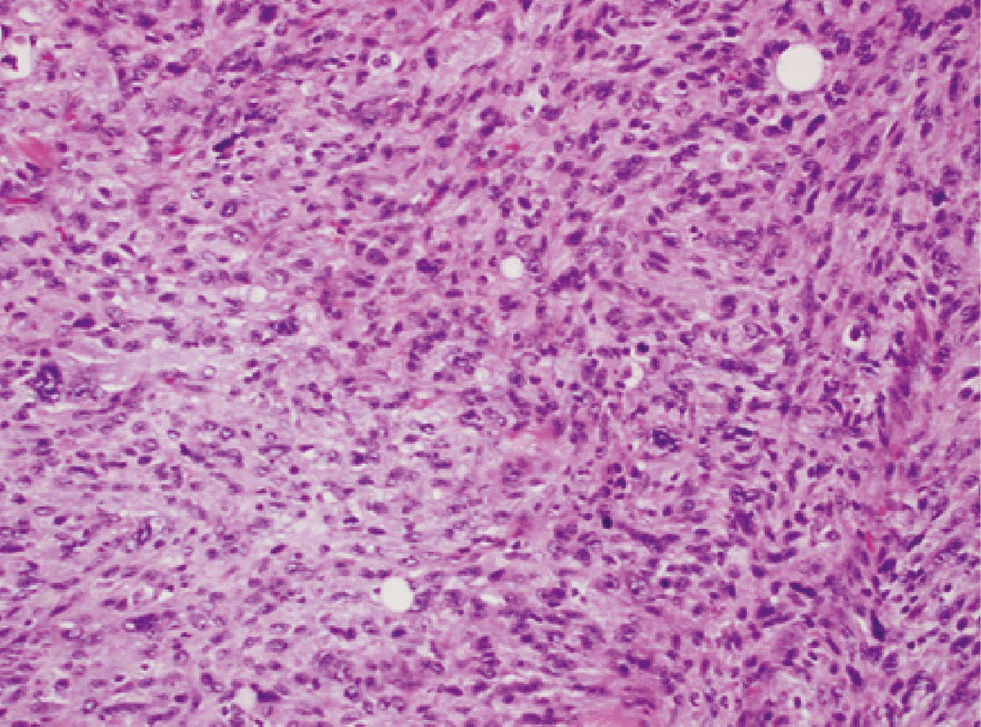 Figure 5: Myofibroblastic sarcoma (hematoxylin and eosin, original magnification ×200).