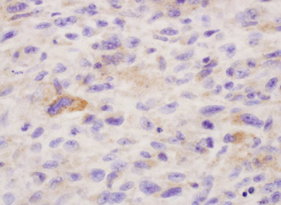 Figure 6: Myofibroblastic sarcoma with focal 2+ cytoplasmic staining for LHRH-R. In a few of the cells, the cytoplasm stains strongly positively by immunochemistry. Other cells show faint or no cytoplasmic staining (immunohistochemistry, original magnification ×600).
