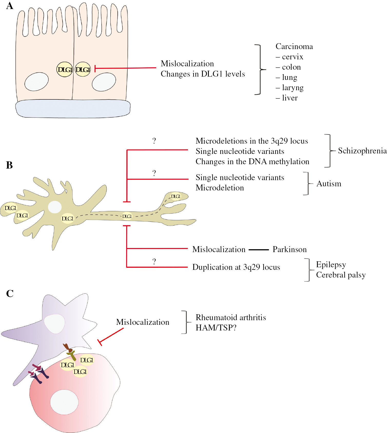 Figure 1: Alterations in DLG1 expression are associated to different human pathologies.(A) Loss of DLG1 normal cell localization at the cell borders and changes in its abundance are observed during epithelial tumor development at diverse anatomical sites. (B) Different neurological diseases are linked to diverse genetic mutations in the DLG1 gene and probably to changes in DNA methylation status. (C) Redistribution of DLG1 in T-lymphocytes with loss of its expression at the immunological synapses can deregulate signaling pathways, driving to inflammatory illnesses.