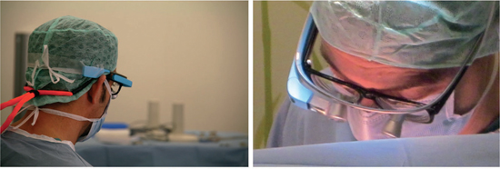 Figure 5 
            (left) Additional fastening with tape, (right) Surgeon wearing Google Glass, magnifying spectacles and ordinary glasses.
          