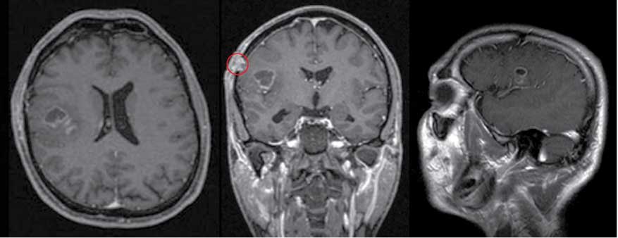 Figure 1 Preoperative magnetic resonance imaging (MRI) showing the right fronto-lateral glioblastoma and the scar tissue (red circle) from the previously performed biopsy. The fMRI image on the far left shows the main lateralization of the language function on the right side anterior to the lesion.