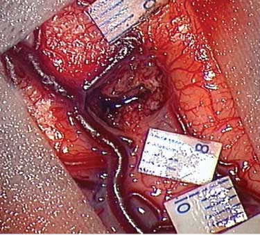 Figure 2 Intraoperative photo showing the stimulation sites. The white pieces of paper on the cortical surface mark the sites with a positive response to cortical stimulation where speech arrests were triggered.