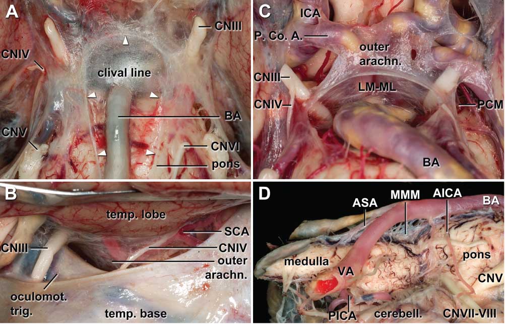Figure 2 Outer and inner arachnoid relations of the tentorial level and the posterior fossa in en-bloc removed brains. (A) The clival line (white arrow-heads). (B) Outer arachnoid relations of the tentorial edge on the left side. Note the arachnoid and dural exit-points of the oculomotor and trochlear nerves. In this case the left temporal lobe was only retracted from the skull base. (C) Overview of the mesencephalic leaf of the Liliequist’s membrane complex. The outer arachnoid of right oculomotor trigone is opened. On the left side the base of the ambient cistern is opened to visualize some trabeculae of the posterior cerebral membrane. Note the transversally oriented arachnoid trabeculae of the mesencephalic leaf under both oculomotor nerves. (D) Overview of the median medullary membrane.a.=artery, AICA=anterior inferior cerebellar artery, arachn.=arachnoid, ASA=anterior spinal artery, BA=basilar artery, cerebell.=cerebellum, CNIII=oculomotor nerve, CNIV=trochlear nerve, CNV=trigeminal nerve, CNVI=abducent nerve, CNVII-VIII=vestibulocochlear and facial nerves, Co.=communicating, ICA=internal carotid artery, LM-ML=mesencephalic leaf of the Liliequist’s membrane complex, MMM=median medullary membrane, p.=posterior, PCM=posterior cerebral membrane, PICA=posterior inferior cerebellar artery, SCA=superior cerebellar artery, temp.=temporal, trig.=trigone, VA=vertebral artery.