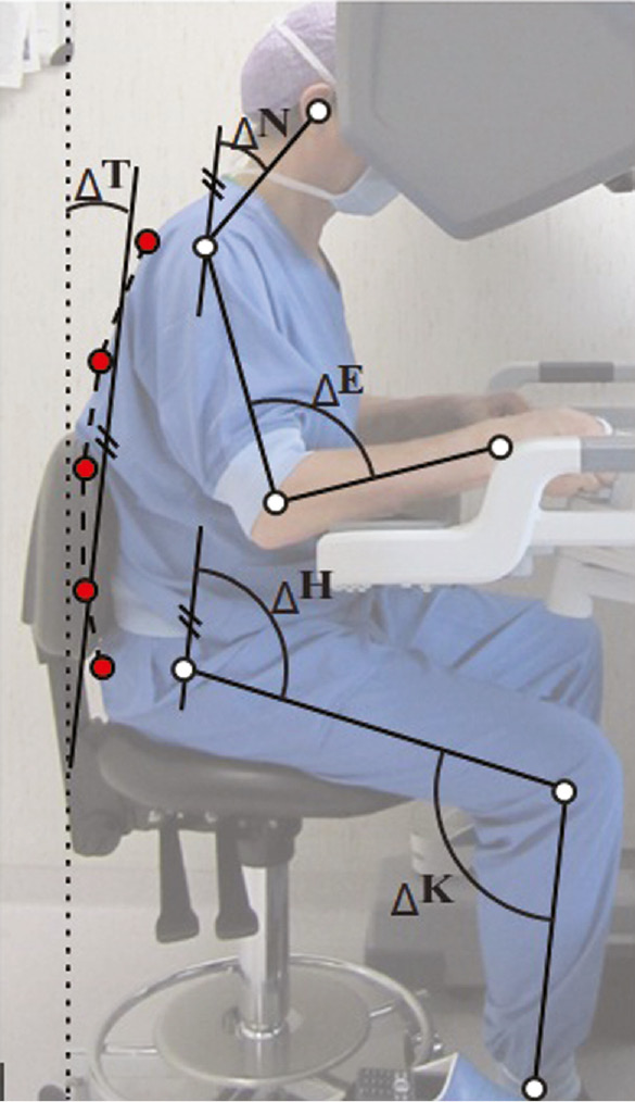 Figure 1: Representation of the angles calculated from the sagittal plane photographs: ΔT (trunk), ΔN (neck), ΔS (shoulder), ΔE (elbow), ΔH (hip), and ΔK (knee).