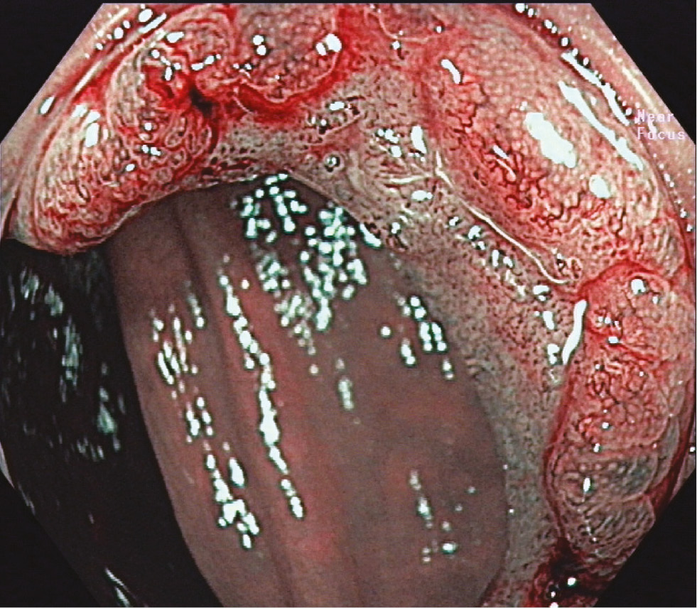 Figure 1: LST nongranular type with a depressed surface.