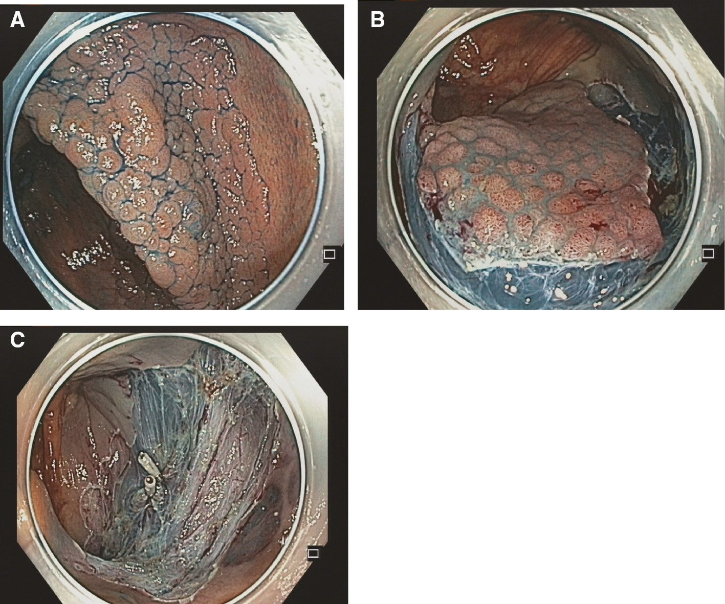Figure 2: (A–C) Piecemeal EMR of an LST granular type in the cecum.