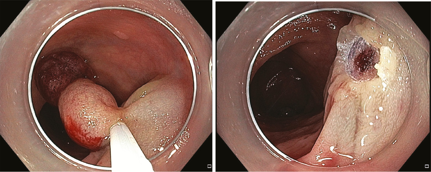 Figure 3: (A and B) Snare EMR of a small pedunculated carcinoma.