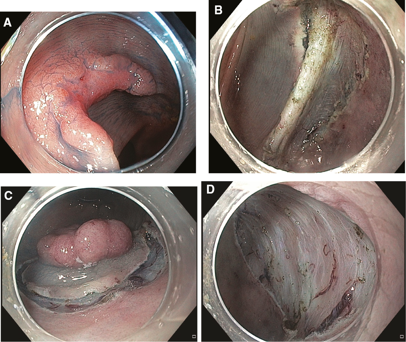 Figure 4: (A and B) ESD resection of an early carcinoma in the transverse colon and (C and D) ESD resection of a rectum adenoma with high-grade intraepithelial neoplasia (HGIEN).