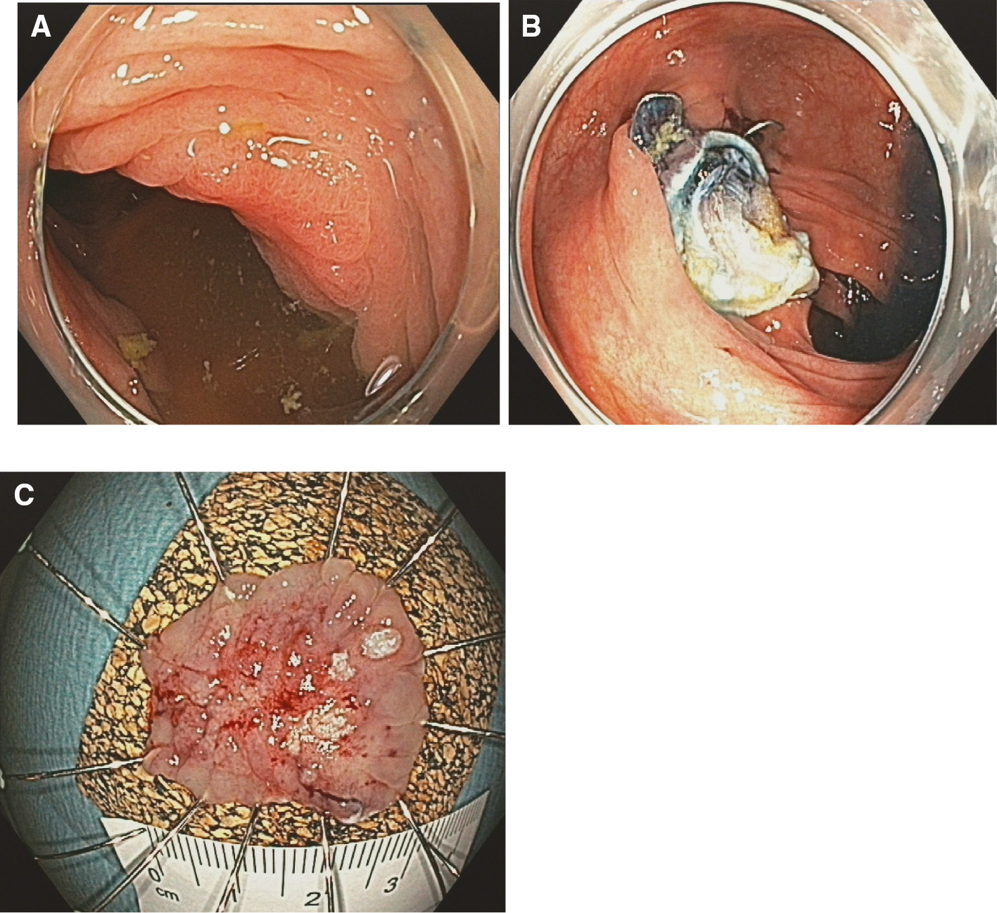 Figure 5: (A–C) EFTR of a T1 carcinoma in the descending colon.
