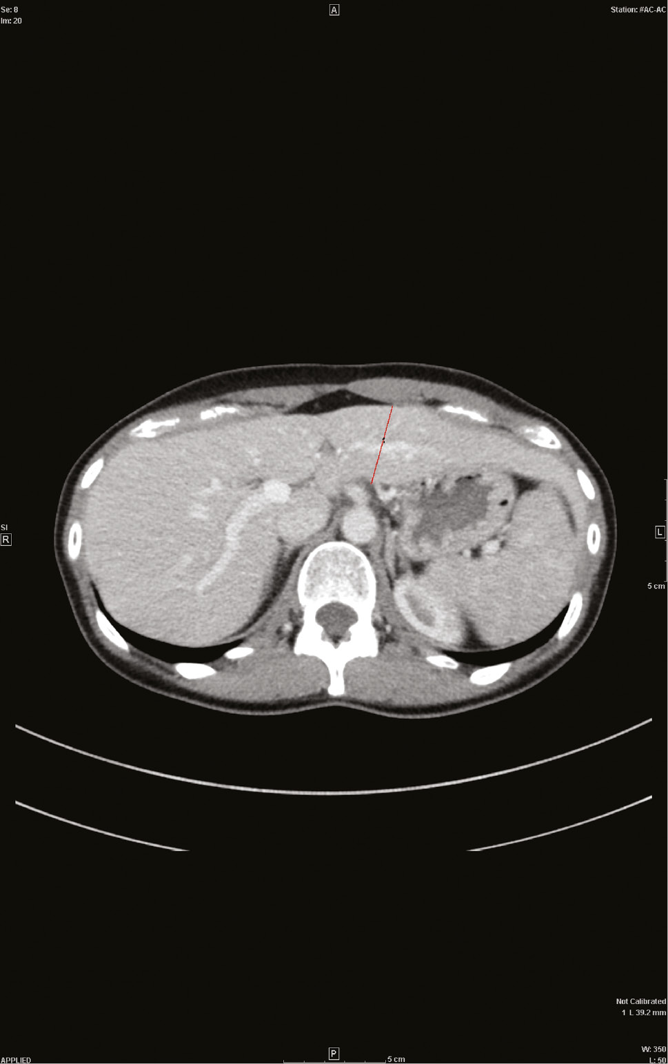 Figure 1: CT of the liver.Axial portal-venous phase CT image with the ventro-dorsal diameter of a female donor liver.