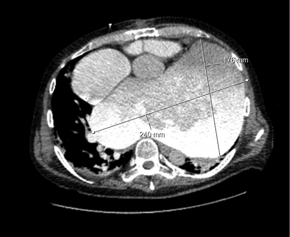 Figure 1: Transversal section of GLA on initial CT after cardiac arrest and CPR (dimensions: 240×176 mm).
