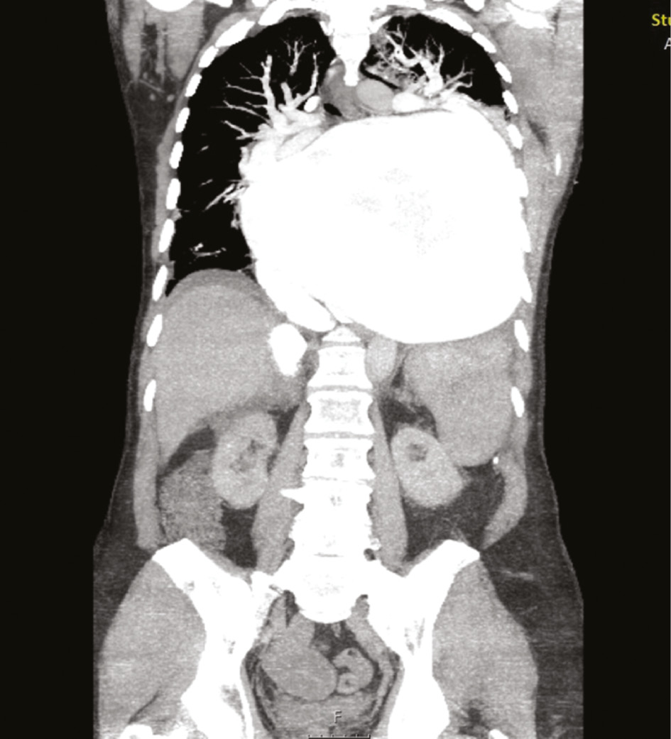 Figure 2: Frontal section of GLA on initial CT.
