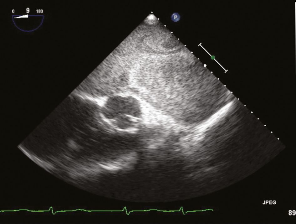 Figure 3: ECG view of GLA with spontaneous contrast/sludge.