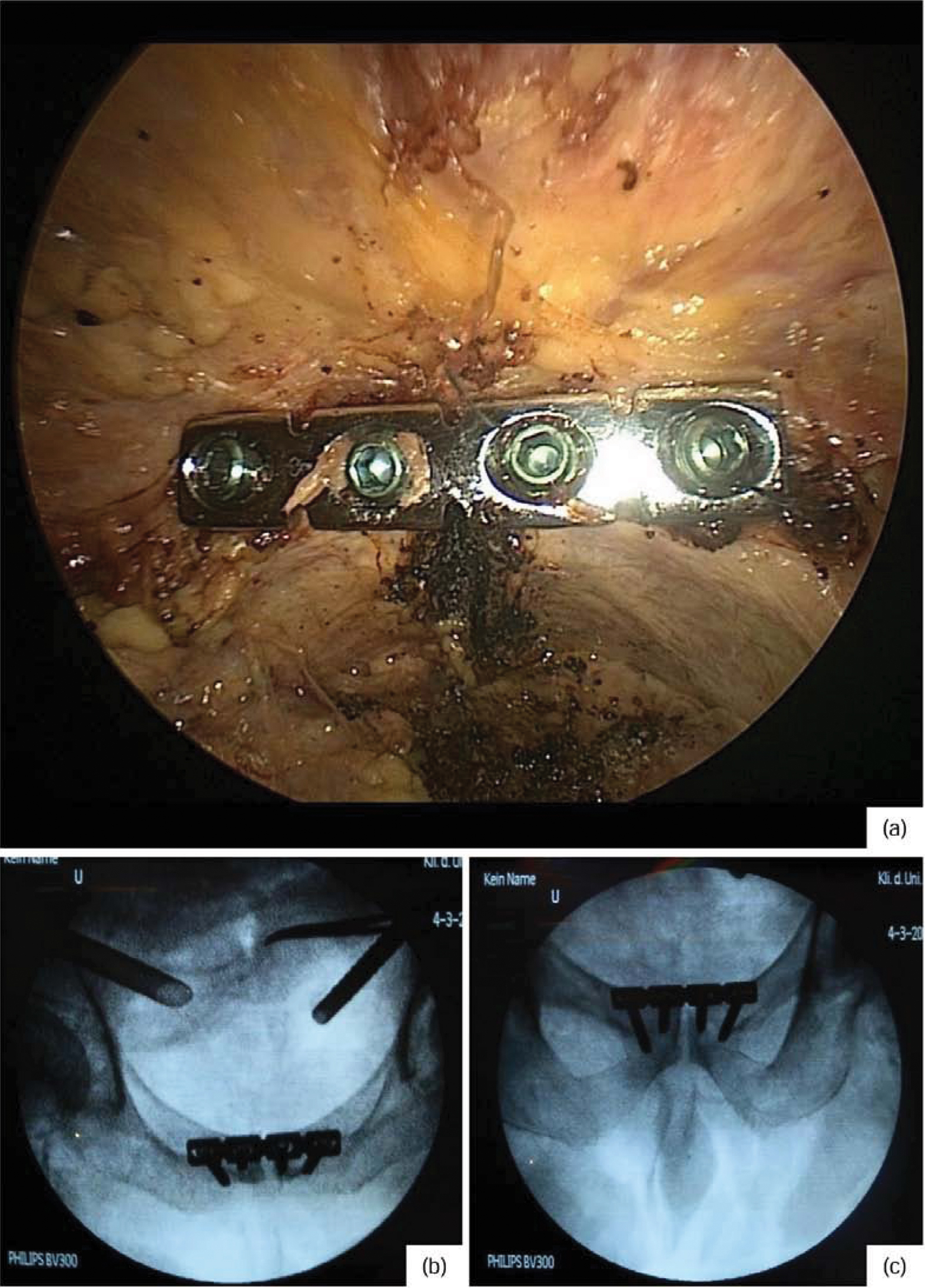 Picture: Final documentation with endoscopic view of the plate (a), as well as radiological control of the plate position in 2 levels (inlet / outlet recording, b and c)