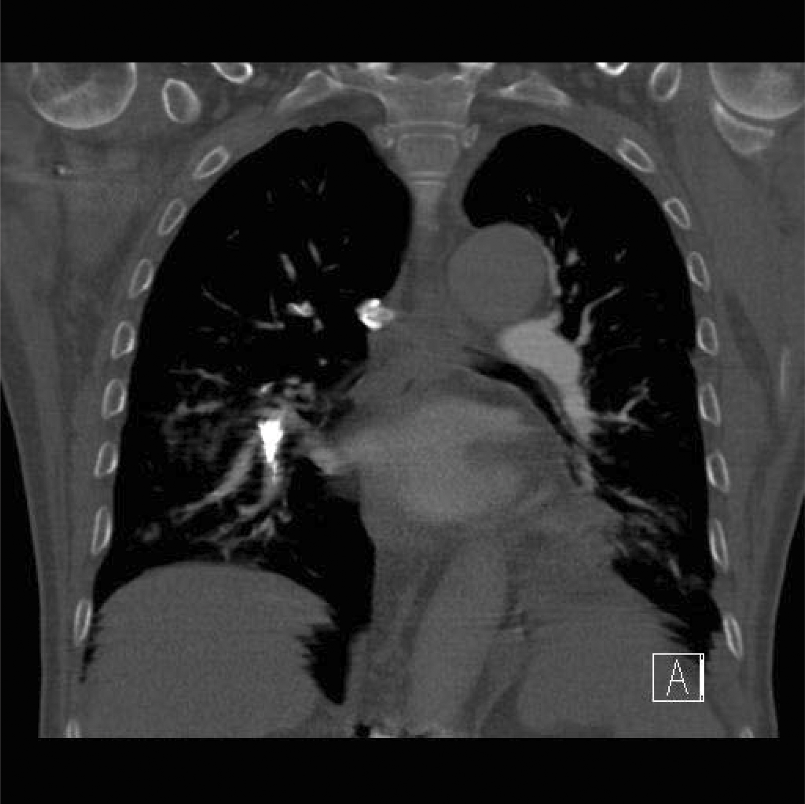 Picture: Lung embolism