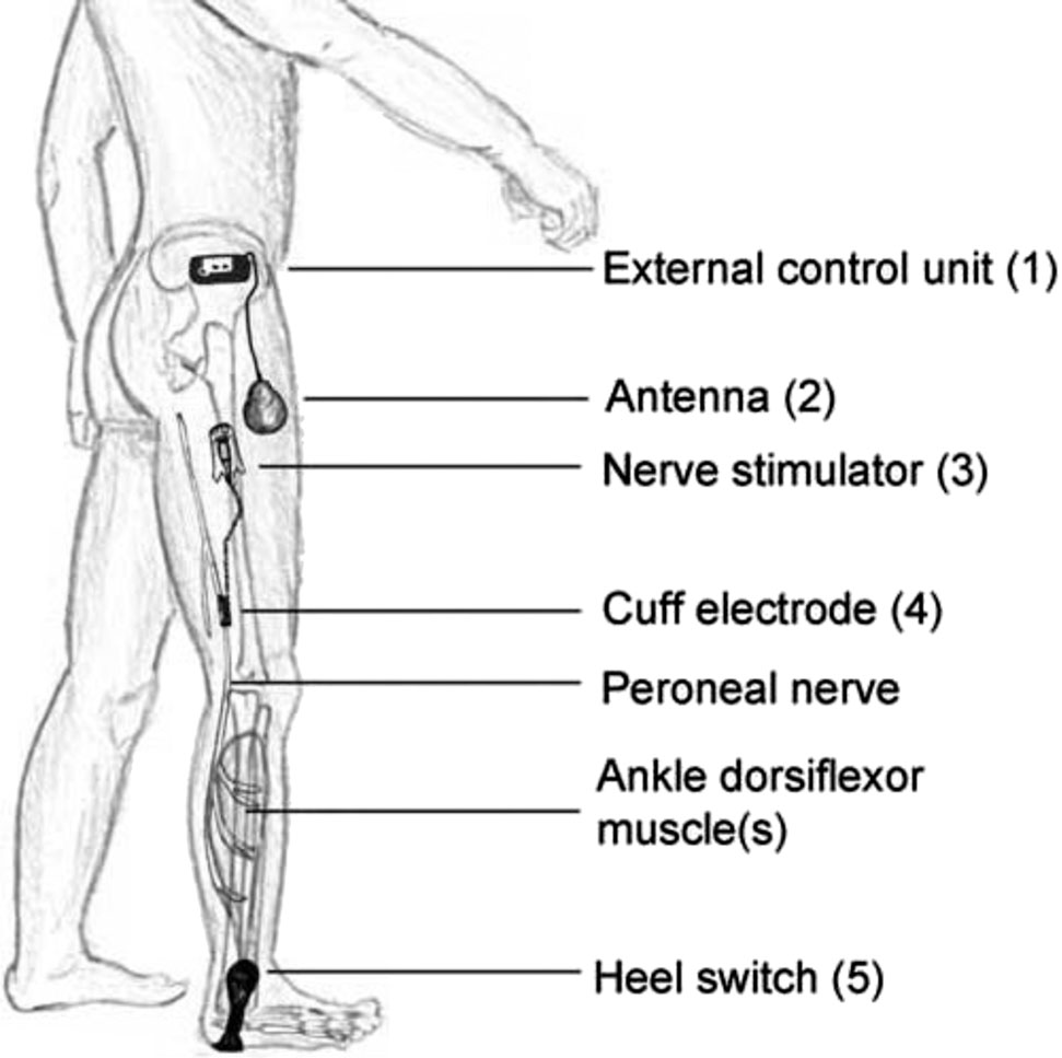Figure 1: Schematic illustration of the implantable and non-implantable components of the ActiGait®-drop foot stimulator. The system consists of an external control unit (1) with a transmission coil (antenna) (2), which receives signals from the external footswitch (5) via a wireless radiofrequency signal. It enables precise activation depending on the gait cycle and allows for the adjustment of the stimulation parameters. The subcutaneously implanted stimulator (3) is connected to the 4-channel cuff (4), which is placed around the peroneal nerve. The stimulator communicates via a wireless radio frequency signal with the antenna and transmits the stimulation signals.