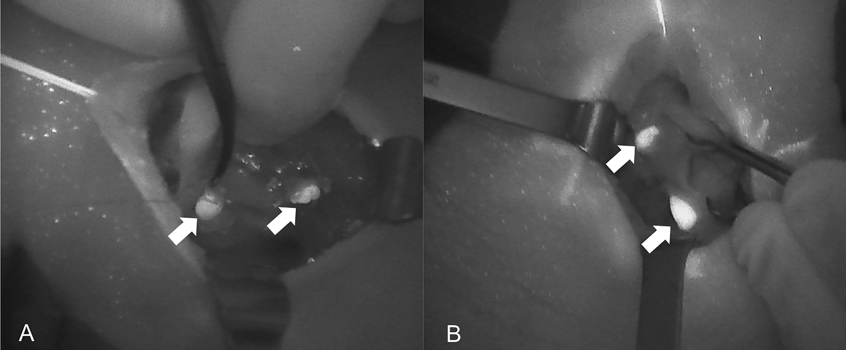 Figure 1: 
Near-infrared autofluorescence (NIRAF) images of normal parathyroid glands (PGs). Arrows indicate localization of Fluobeam LX. (A) Image of the right side after thyroidectomy. (B) Image of the right side in a case of primary hyperparathyroidism.
