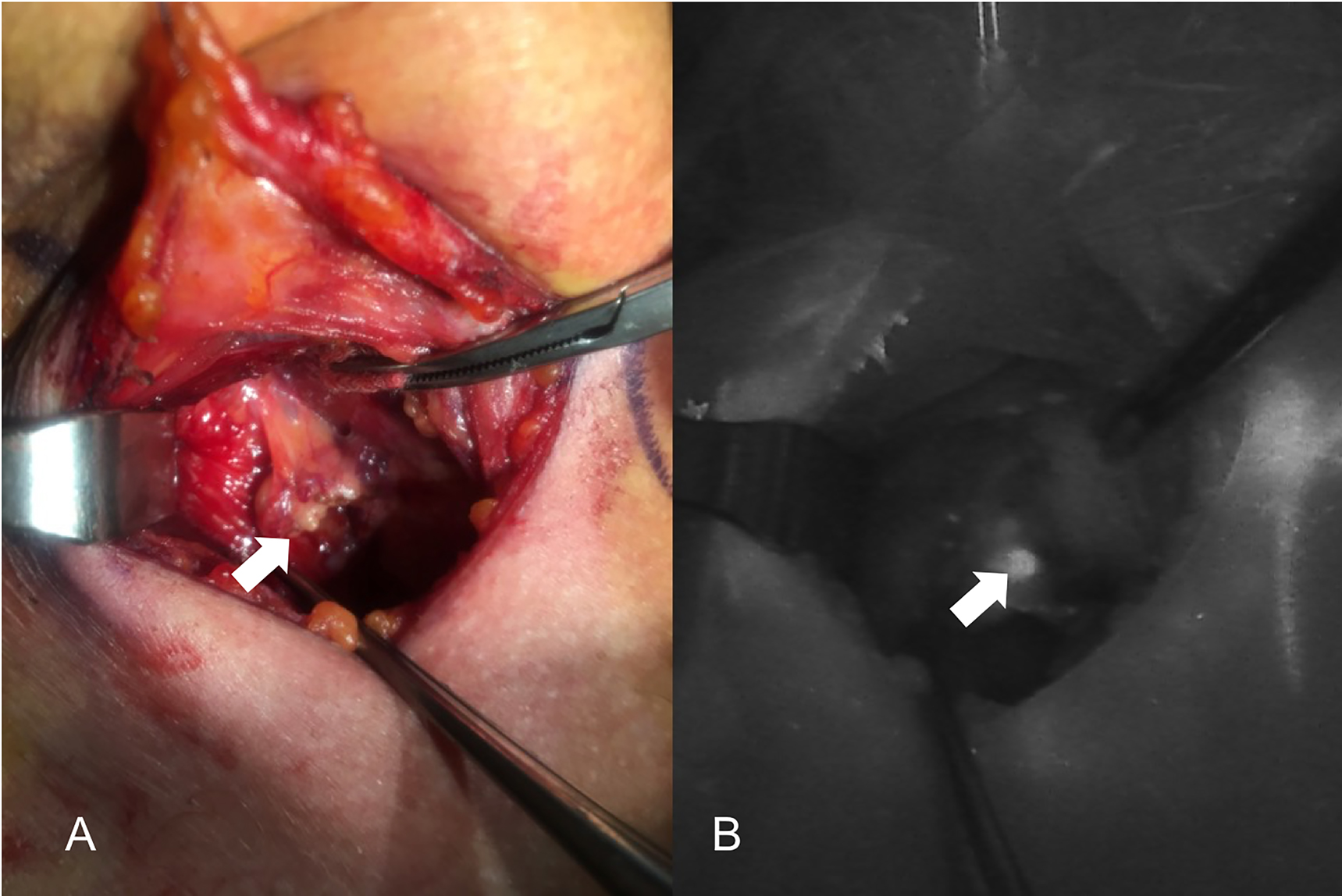 Figure 2: 
Comparison of unaided visualization (A) and near-infrared autofluorescence (NIRAF) imaging using Fluobeam LX (B) of the left side superior parathyroid. The parathyroid gland (PG) is indicated with the white arrow.
