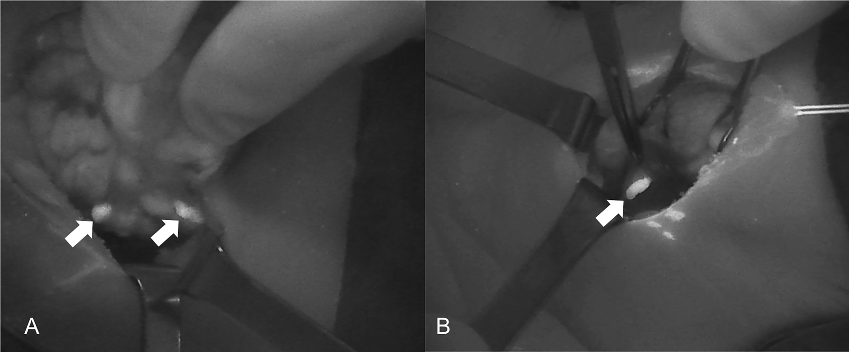 Figure 3: 
Near-infrared autofluorescence (NIRAF) images using Fluobeam LX showing the autofluorescence of the parathyroid glands (PGs). (A) Two PGs after superior pole dissection and the medialization of the right thyroid lobe. (B) Superior PG after medialization of the left thyroid lobe. PGs are indicated with white arrows.

