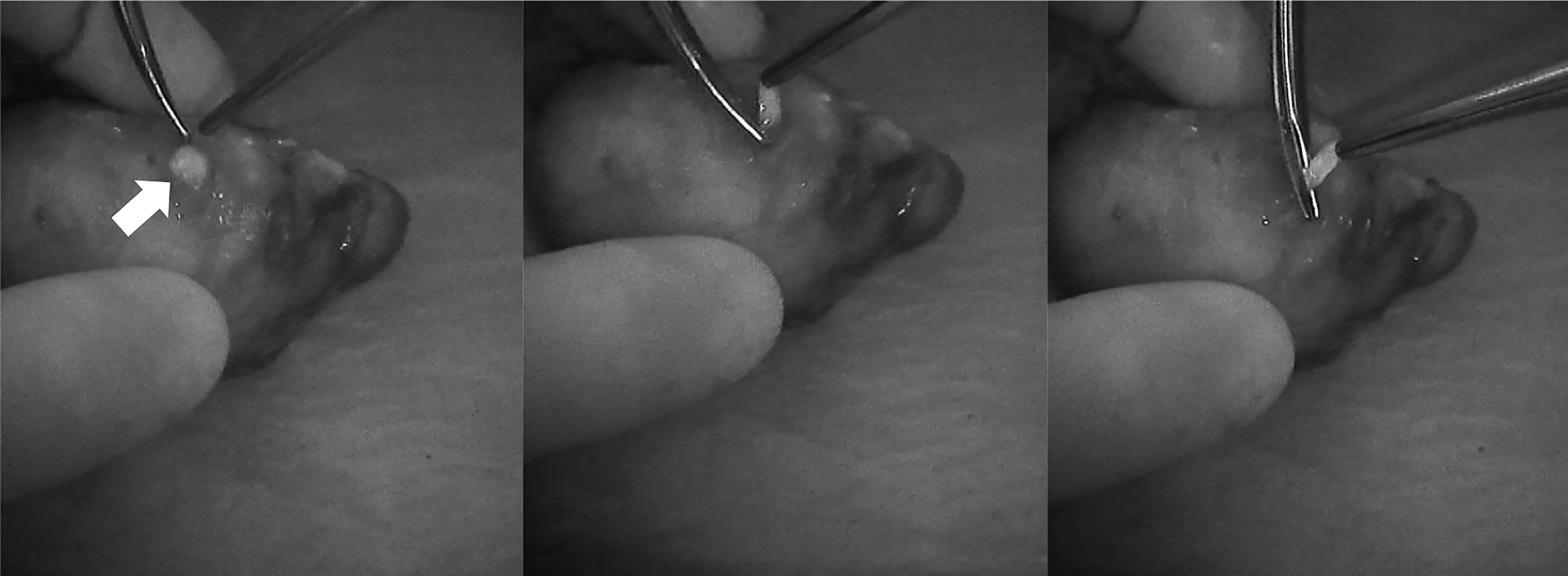 Figure 4: 
Three phases of dissection of subcapsular parathyroid (indicated with a white arrow), which was detected using Fluobeam LX near-infrared autofluorescence (NIRAF) imaging. The parathyroid gland (PG) can then be transplanted.

