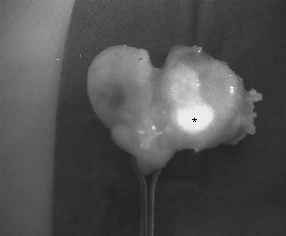 Figure 5: 
An intrathyroidal parathyroid gland (PG) (indicated with *) detected using Fluobeam LX near-infrared autofluorescence (NIRAF) imaging. The PG can be dissected and transplanted.
