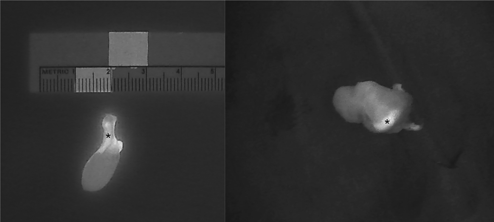 Figure 6: 
Intraoperative near-infrared autofluorescence (NIRAF) images of parathyroid adenomas after resection, demonstrating the heterogeneous and less intense fluorescence pattern that differentiates diseased parathyroid glands (PGs) from normal PGs (indicated with *). Frequently, the most intense NIRAF signal comes from residual normal parathyroid tissue in the adenoma.
