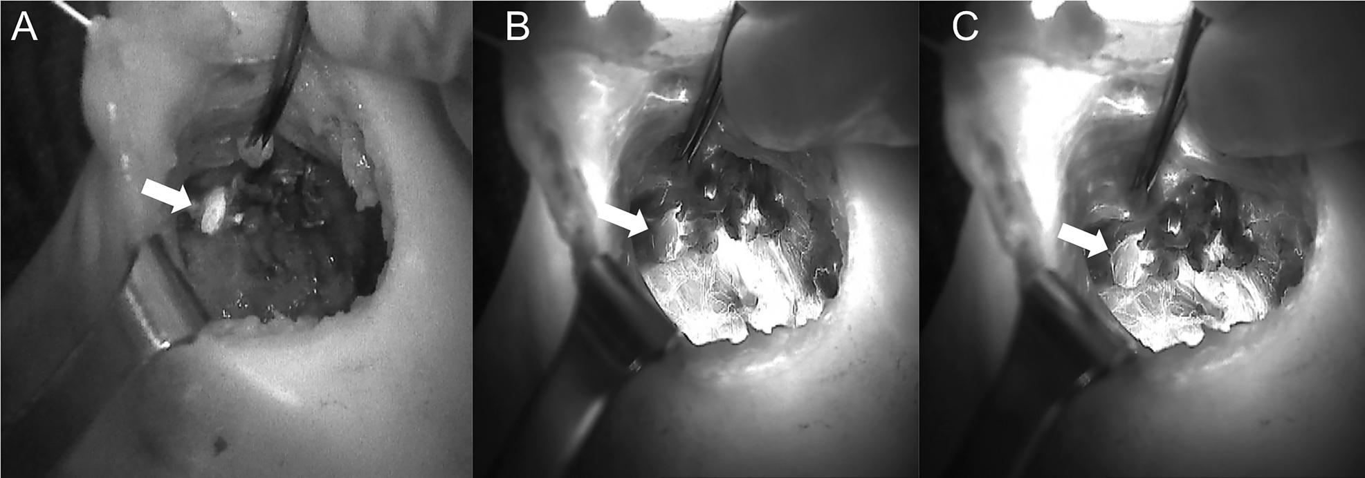 Figure 7: 
A sequence of near-infrared autofluorescence (NIRAF) images showing a parathyroid gland (PG), indicated with a white arrow. (A) Autofluorescence of the PG prior to injection of indocyanine green (ICG). (B) and (C) Diffusion of the ICG contrast agent, showing a well-vascularized PG.
