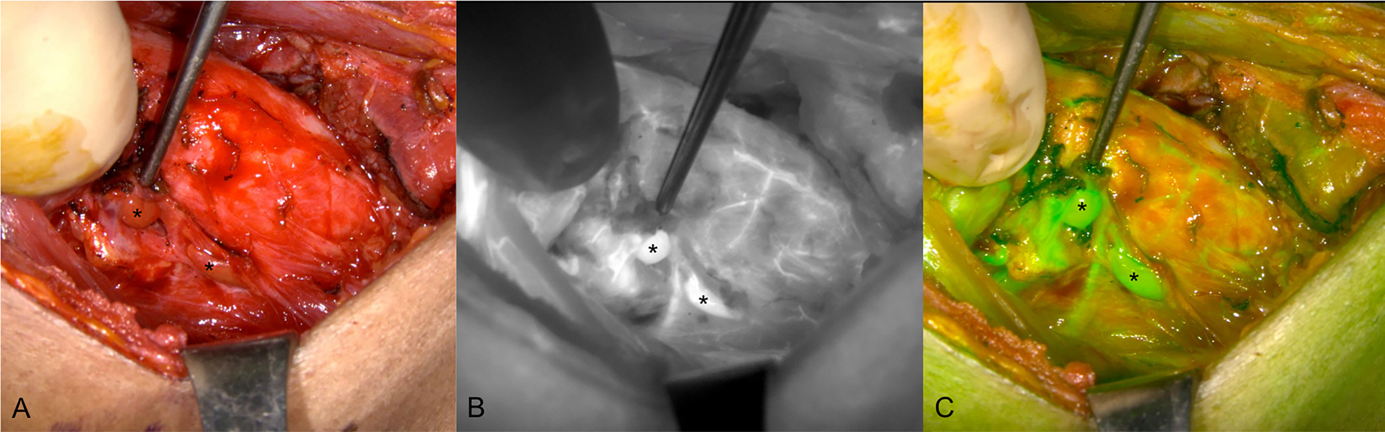 Figure 8: 
Indocyanine green (ICG) angiography images of the right side parathyroid glands (PGs) (indicated with *) after thyroidectomy surgery. (A) Unaided visualization of the tissue. (B) Near-infrared autofluorescence (NIRAF) grayscale image and (C) Green fused image showing two well-vascularized PGs after injection of ICG.
