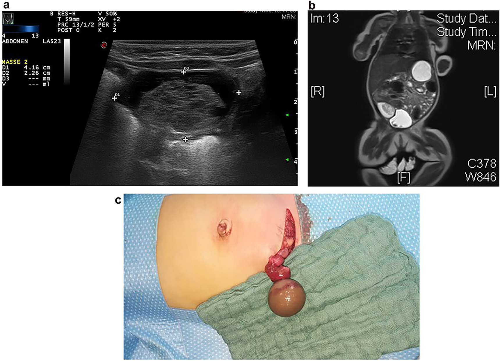 Figure 2a–c: 
Sonography (a) and MRI (b) findings showed a cystic mass in a 6 week old infant with hemorrhagic solid mass and fibrous septation of the cystic mass typically suggesting ovarian necrosis. Intraoperative situs (c) revealed an old (intrauterine) ovarian torsion with a necrotic ovary.
