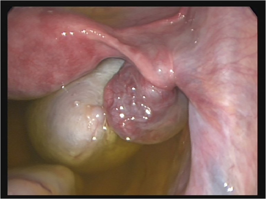 Figure 4: 
Intra-OP picture of ovarian torsion with vital ovary. Laparoscopic detorsion is warranted to preserve the ovary timely.
