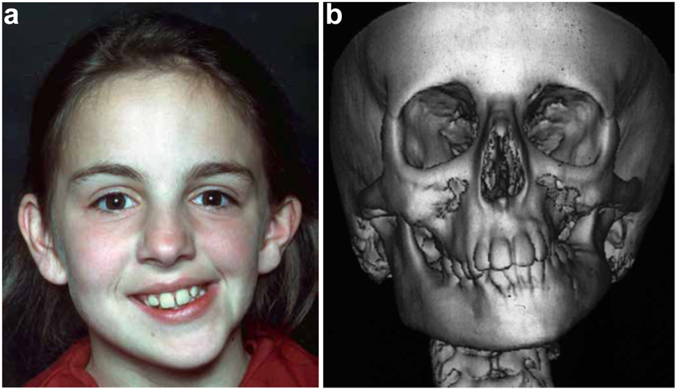 Figure 1: 
Clinical and CT example of Class II classification of HFM. (a) and (b) Example of Pruzansky IIa HFM aged 12 yrs.