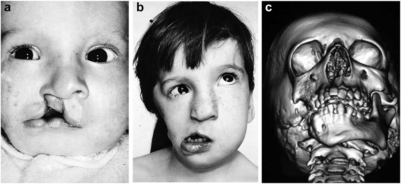 Figure 2: 
Clinical and CT examples of Class III classification of HFM. (a) Baby with Pruzansky III HFM. (b) Same child 10 yrs later. (c) 3DCT of an example of Pruzansky III HFM.