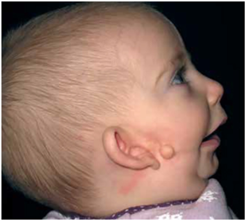 Figure 3: 
Clinical example of an incomplete Tessier no. 7 facial cleft.