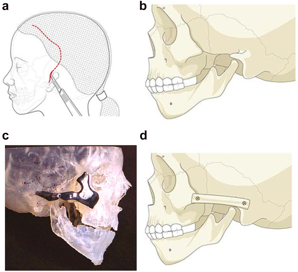 Figure 4: 
Planning for construction of missing zygomatic bone parts. (a) The placement of this incision needs to take into consideration the need for any future ear construction and avoid limiting soft-tissue cover. If a patient has microtia with limited skin and a low hairline, a temporoparietal fascial flap covering either a cartilage or porous polyethylene implant may be required. In these instances, the microtia repair should be considered first or the incisional approach modified to preserve the flap. (b) Absent zygomatic arch. (c) Guide for zygomatic arch + construction. (d) Illustration of the arch constructed.