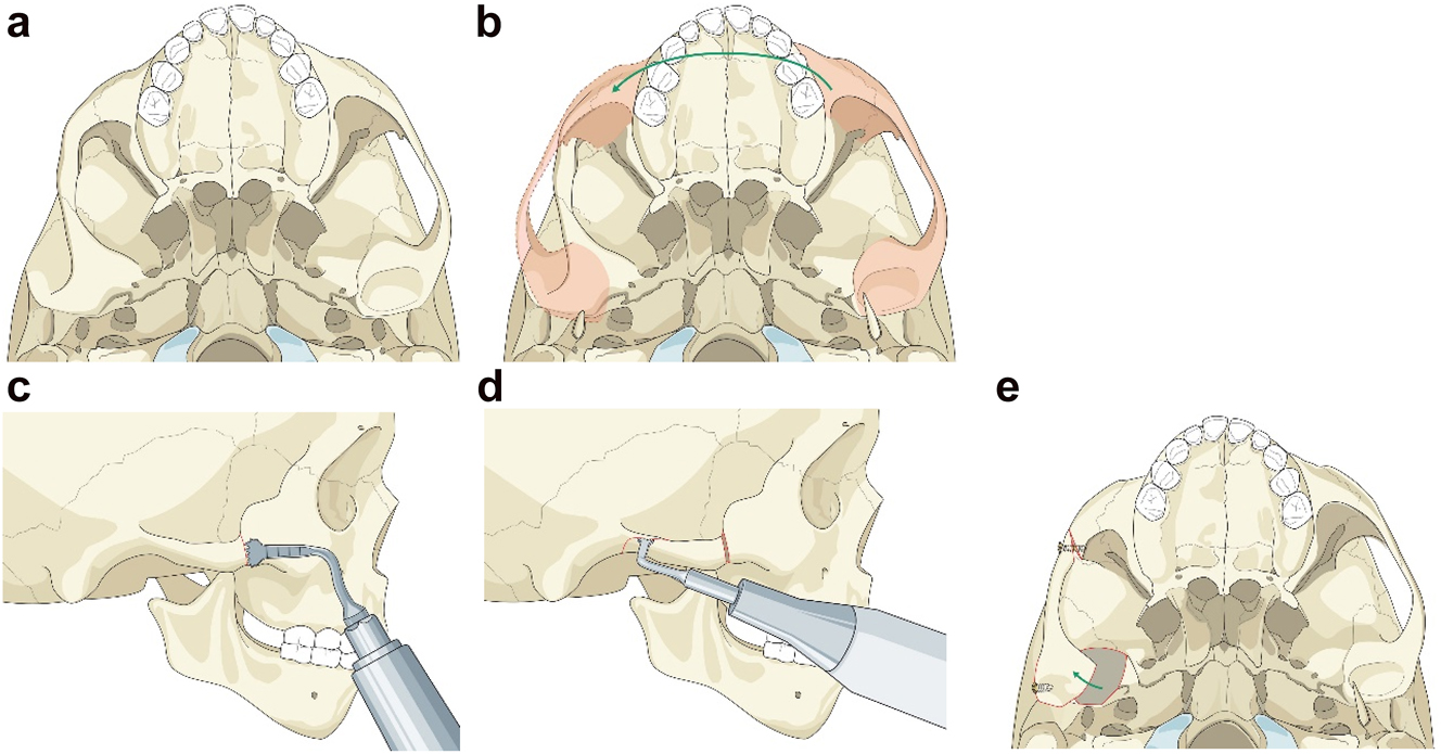 Figure 5: 
Planning for moving an aberrant glenoid fossa. (a–e) Illustrations simulating the movements required (a and b) and below the osteotomies made (c–e).