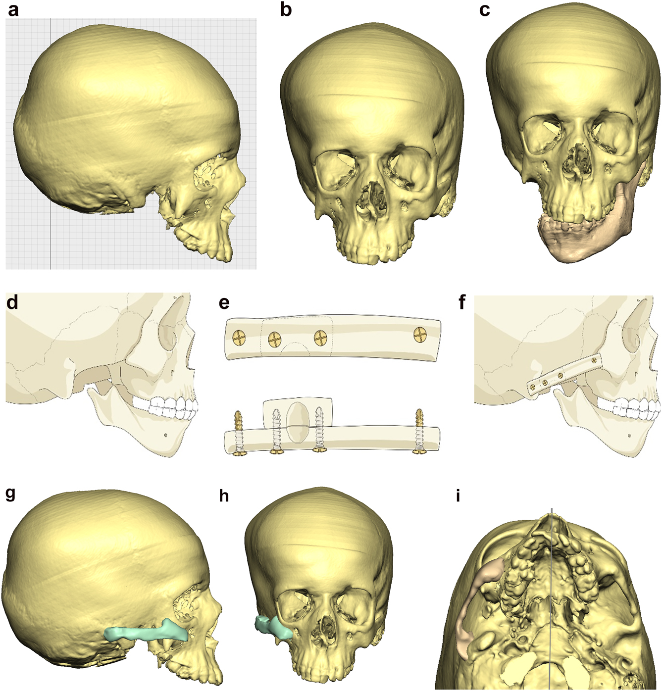 Figure 6: 
Planning for construction of missing zygomatic bone, glenoid fossa and mandible. (a–c) A severe PK III case (same case as Figure 2c) without and with the mandible. (d–f) The principle of arch/fossa construction with rib grafts. (g–i) Simulations in freeform of construction of the zygomatic arch and glenoid fossa (same case as Figure 2c, and Figure 5a–c).