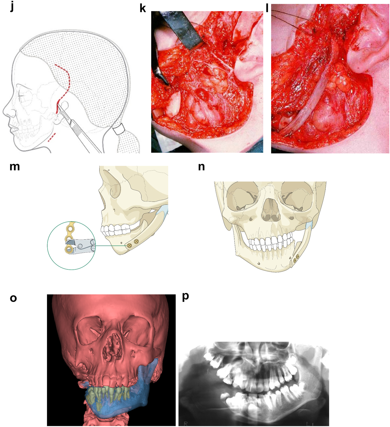 Figure 6: 
Planning for construction of missing zygomatic bone, glenoid fossa and mandible. (j) The surgical approach. (k) The facial nerve dissected. (l) A long costo-chondral graft inserted (Figure 6k and j are a different case from the rest of Figure 6). (m and n) Illustrations of the grafts inserted and fixed and a defect between the mandible and rib graft filled with further rib graft. (o and p) Transparency 3D CT view in Mimics and OPT of same case as Figure 2c showing the buried teeth and roots in the mandible indicating that the costo-chondral graft construct has to be extended anteriorly over the chin to permit safe fixation with two screws.